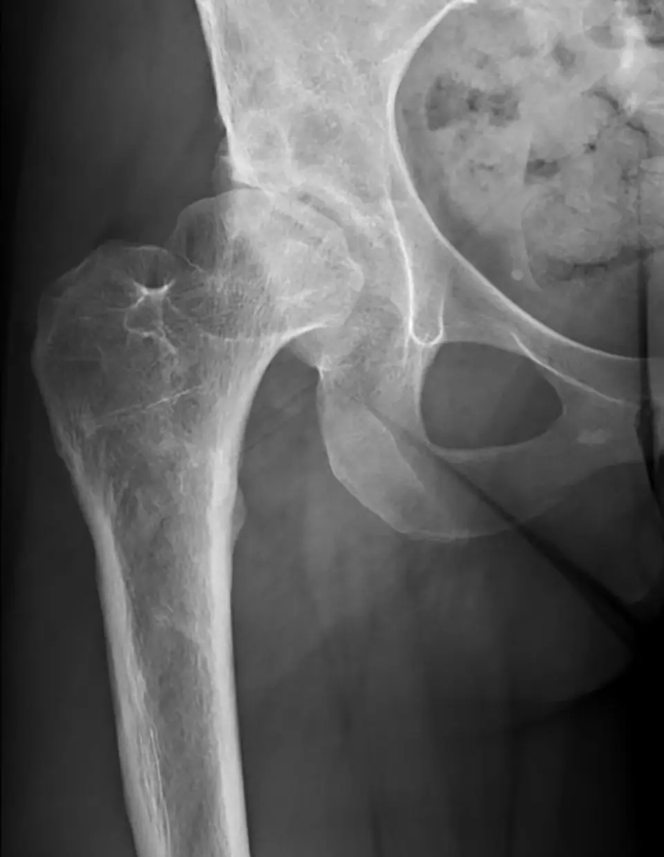 Developmental Dysplasia of the Hip