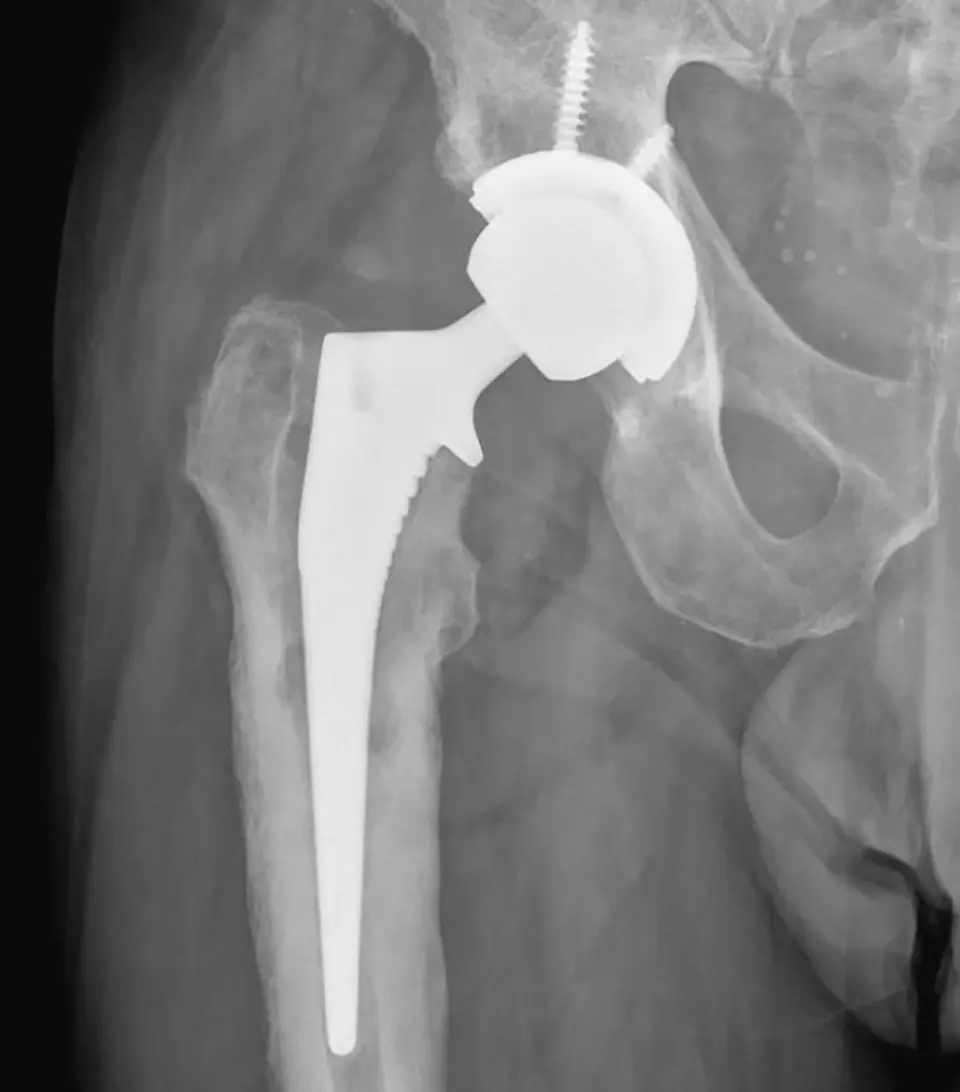 Failing Total Hip Replacement