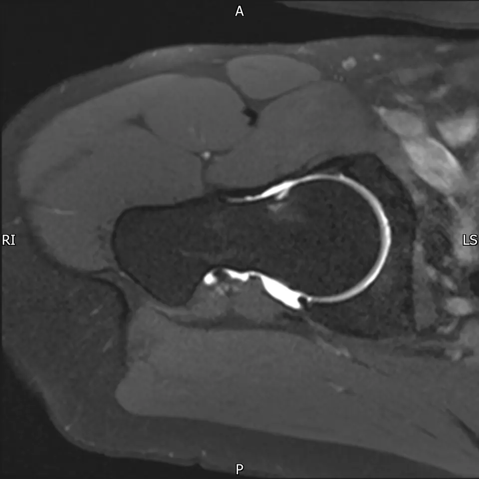 Hip Impingement