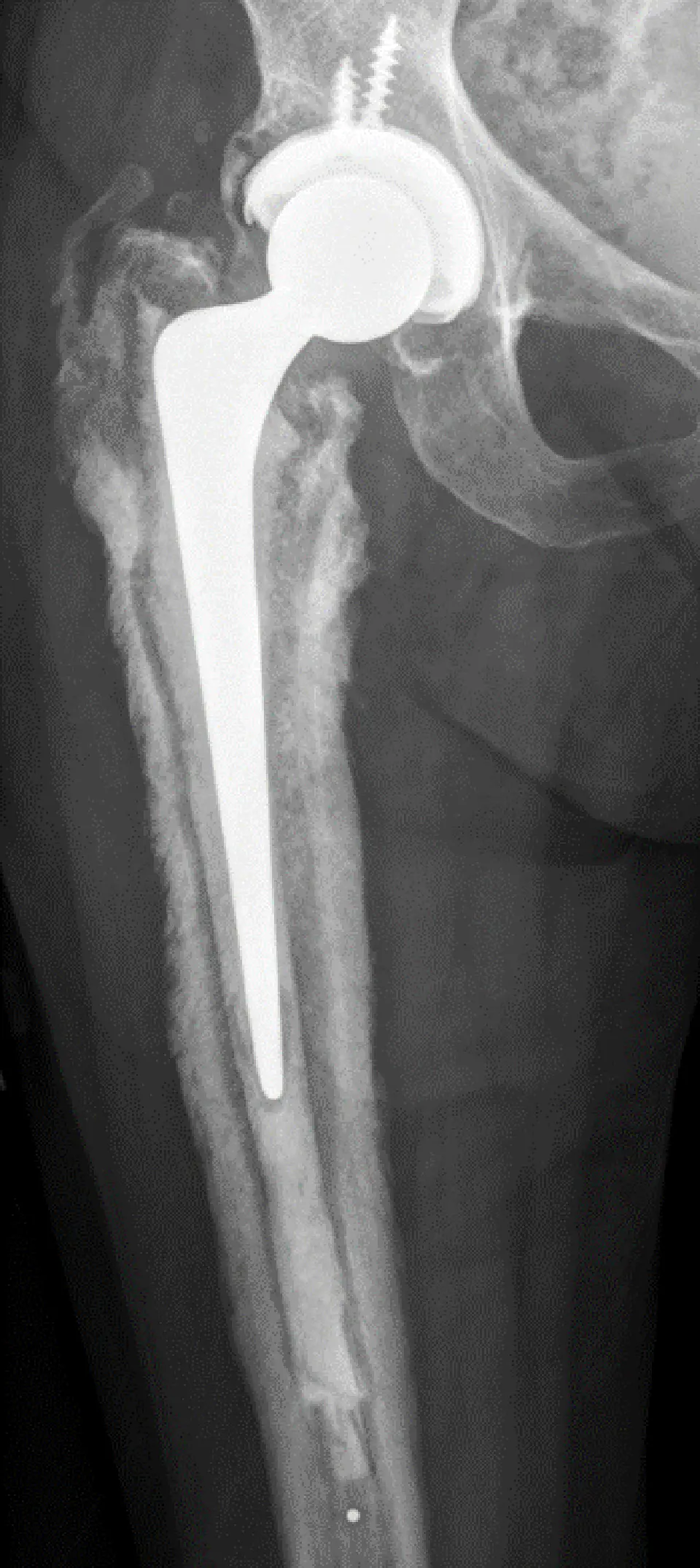 Infected Total Hip Replacement