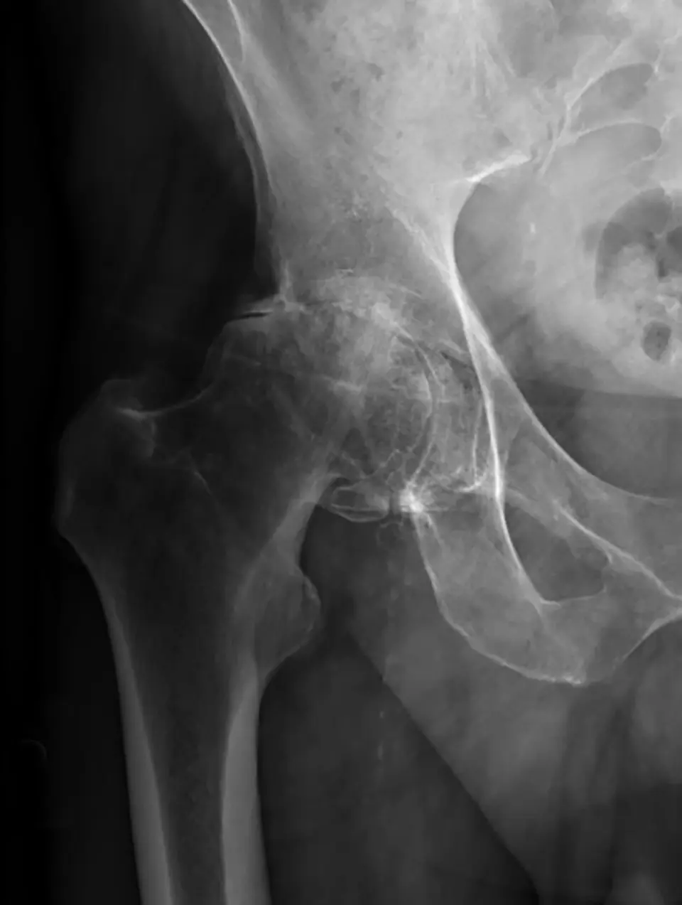 Hip Osteoarthritis