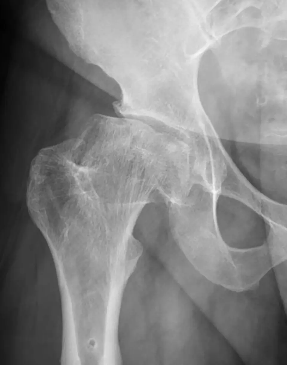 Skeletal Dysplasia