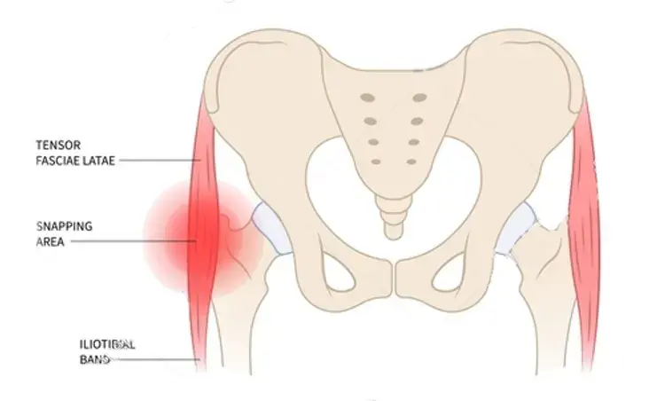 Trochanteric Bursitis